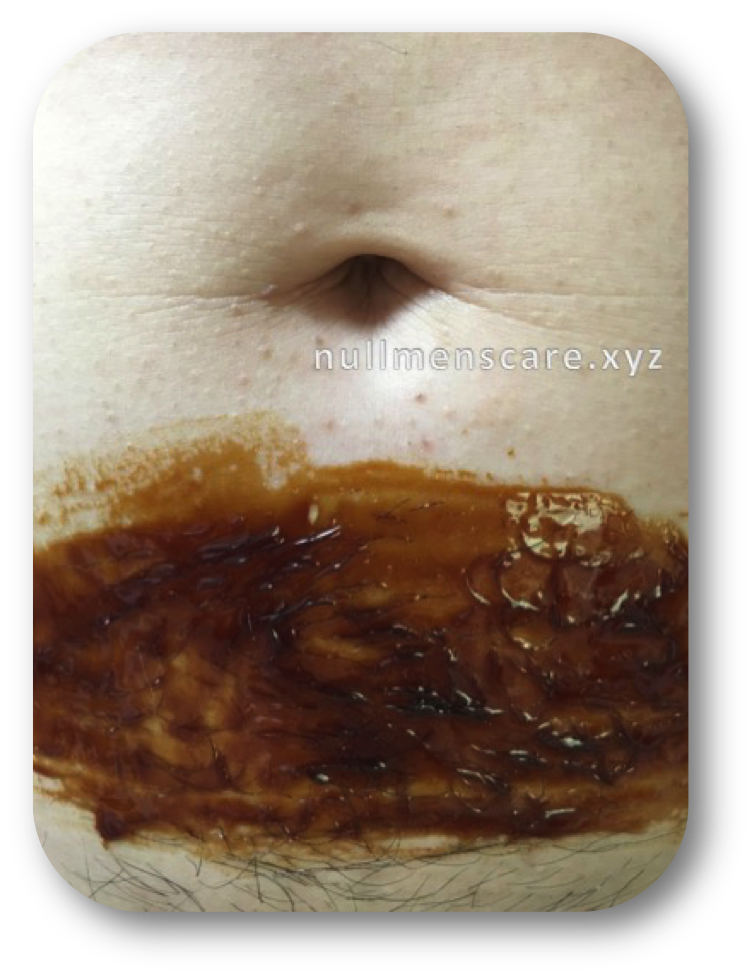 Nullブラジリアンワックス塗布